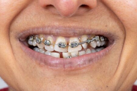 The Dangers of Smoking With Braces